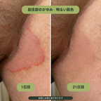 鼠径部用バー