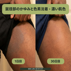 鼠径部用バー