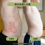 鼠径部用バー